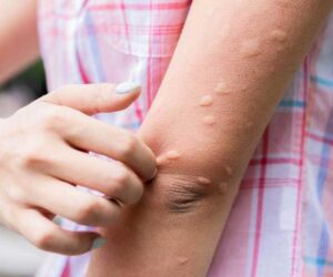 Japanese encephalitis